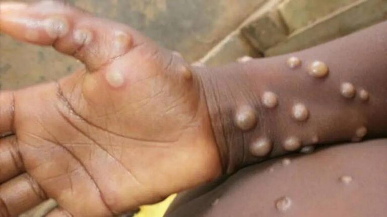 Artibonite: un cas de la variole du singe, découvert